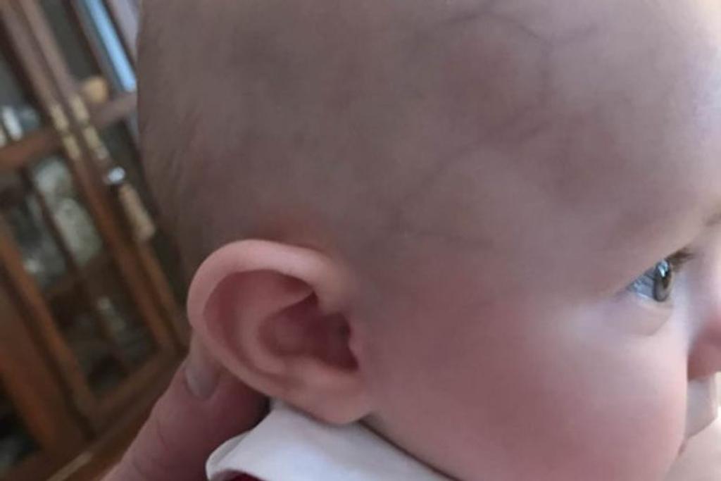 vein pattern baby birthmark