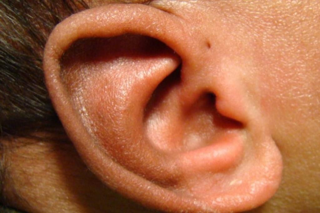 Preauricular pits Ear Hole