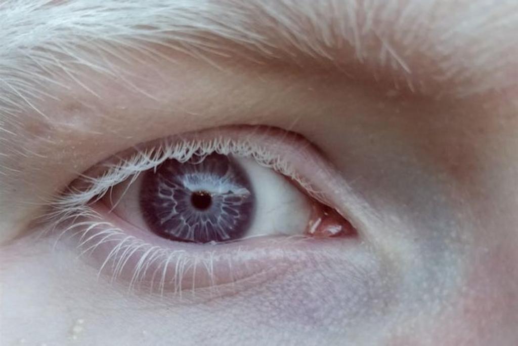 albinism purple eyes