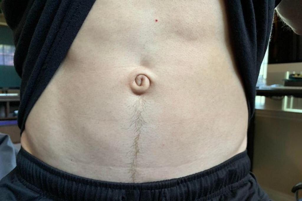Swirl bellybutton rare condition