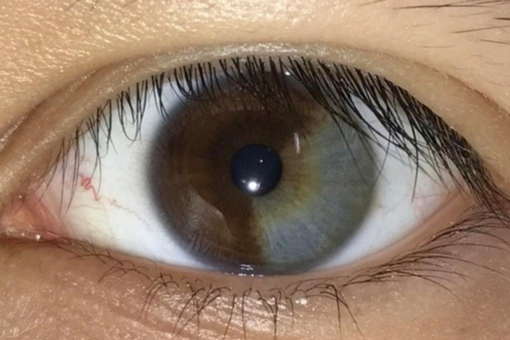 Heterochromia Beautiful Eye Human