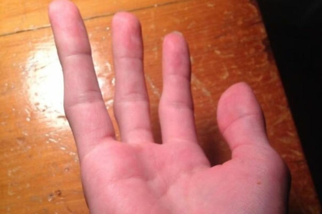 Four Fingers Birth Defect