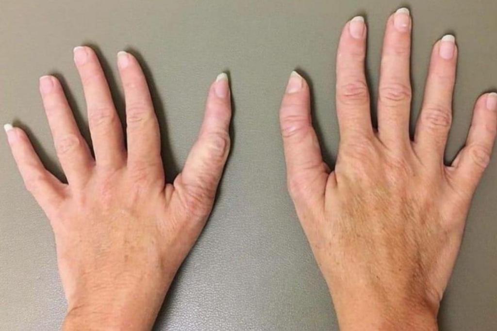 triphalangeal thumb Born Different