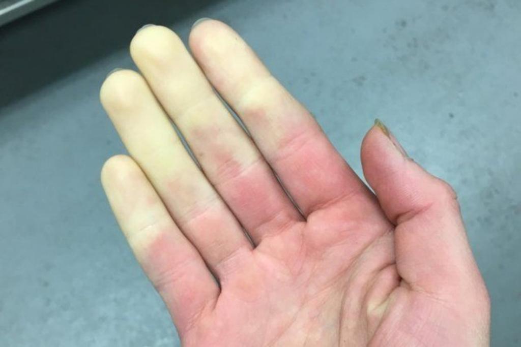 Raynaud's condition fingers toes