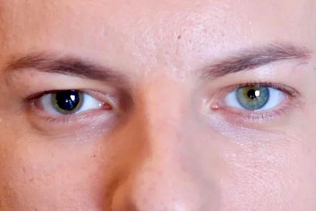 Different Size Pupils Eyes