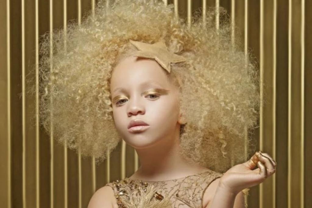 Ava Edney albinism model