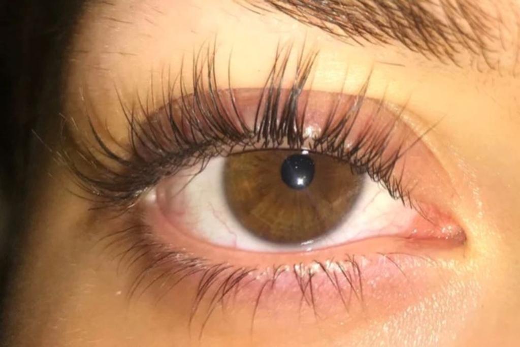 Distichiasis Abnormally long lashes