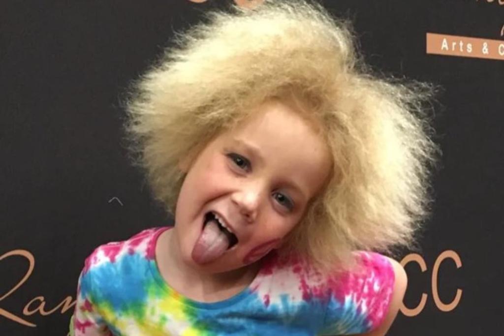uncombable hair syndrome Shilah 