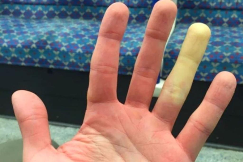 Raynaud's finger rare condition