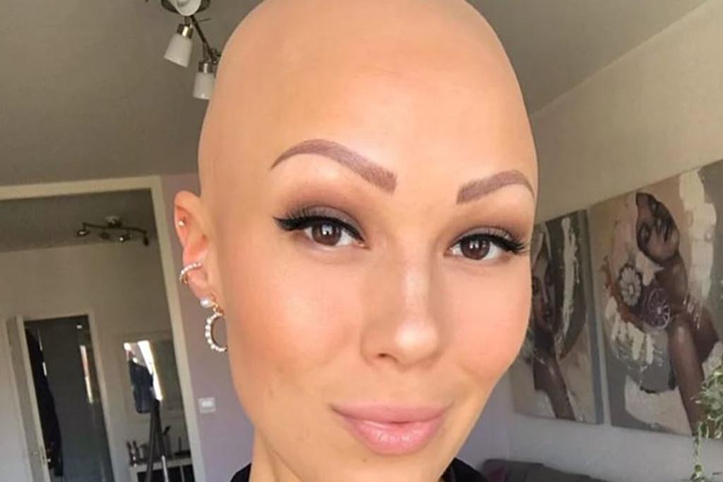 alopecia bald woman condition 