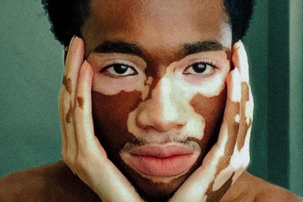 male model vitiligo pigment