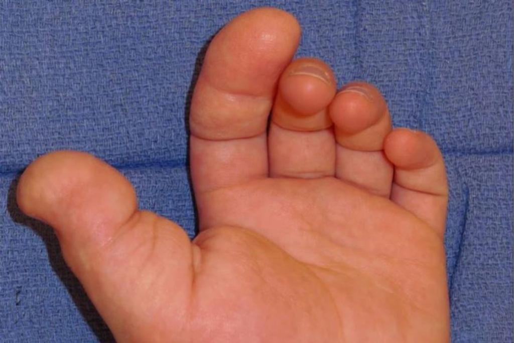 macrodactyly abnormal hand vessel 