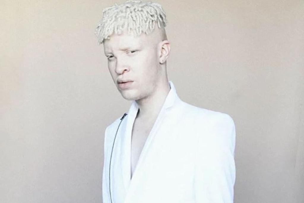 Shaun Ross congenital albinism 