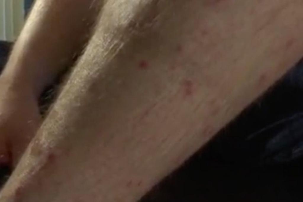 Austin Bohanan Bites Bug